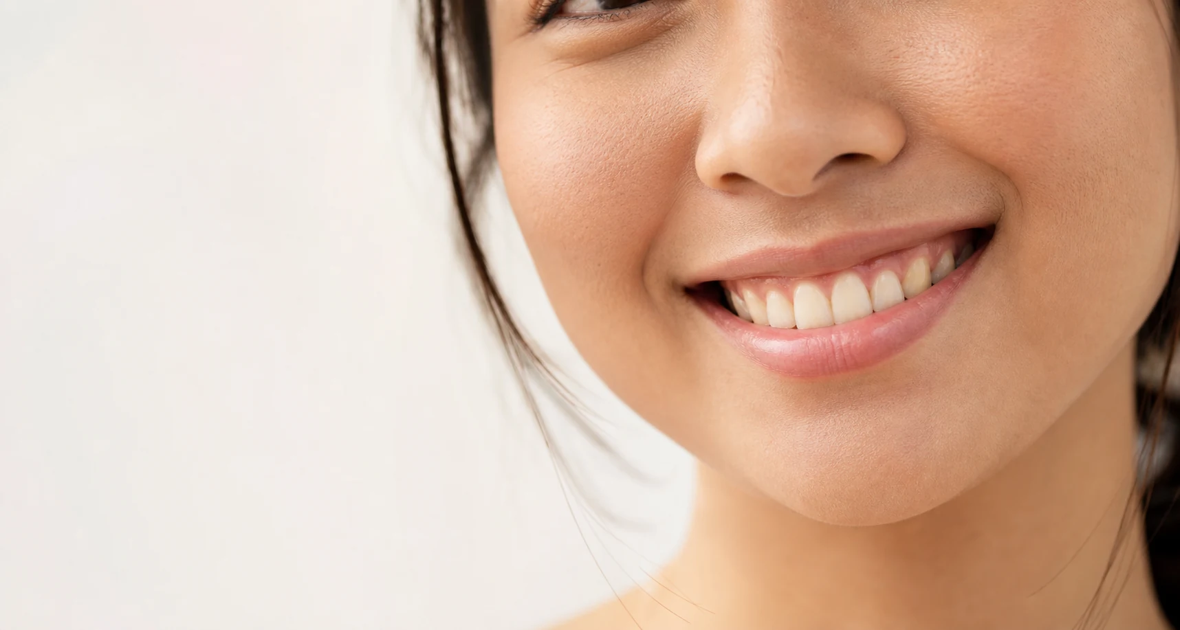 Senyum natural pasien Mozza Dental