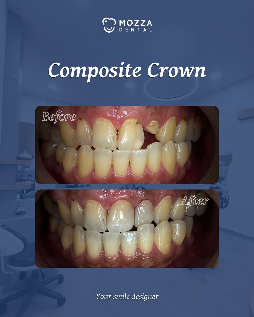 Composite Crown Case