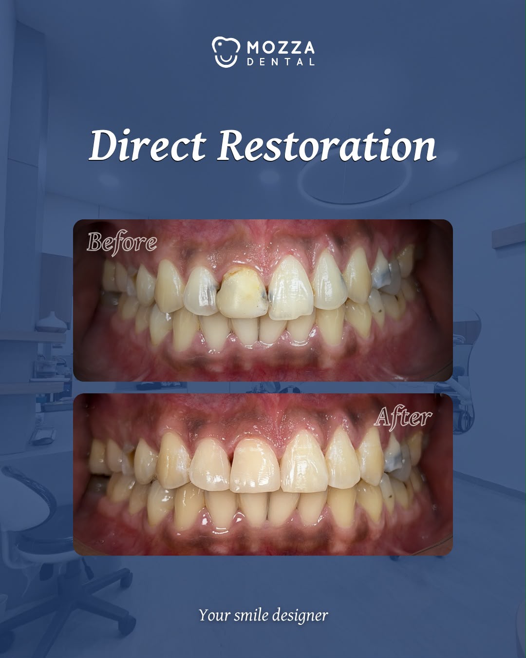 Direct Restoration (Tambal Gigi Estetik)