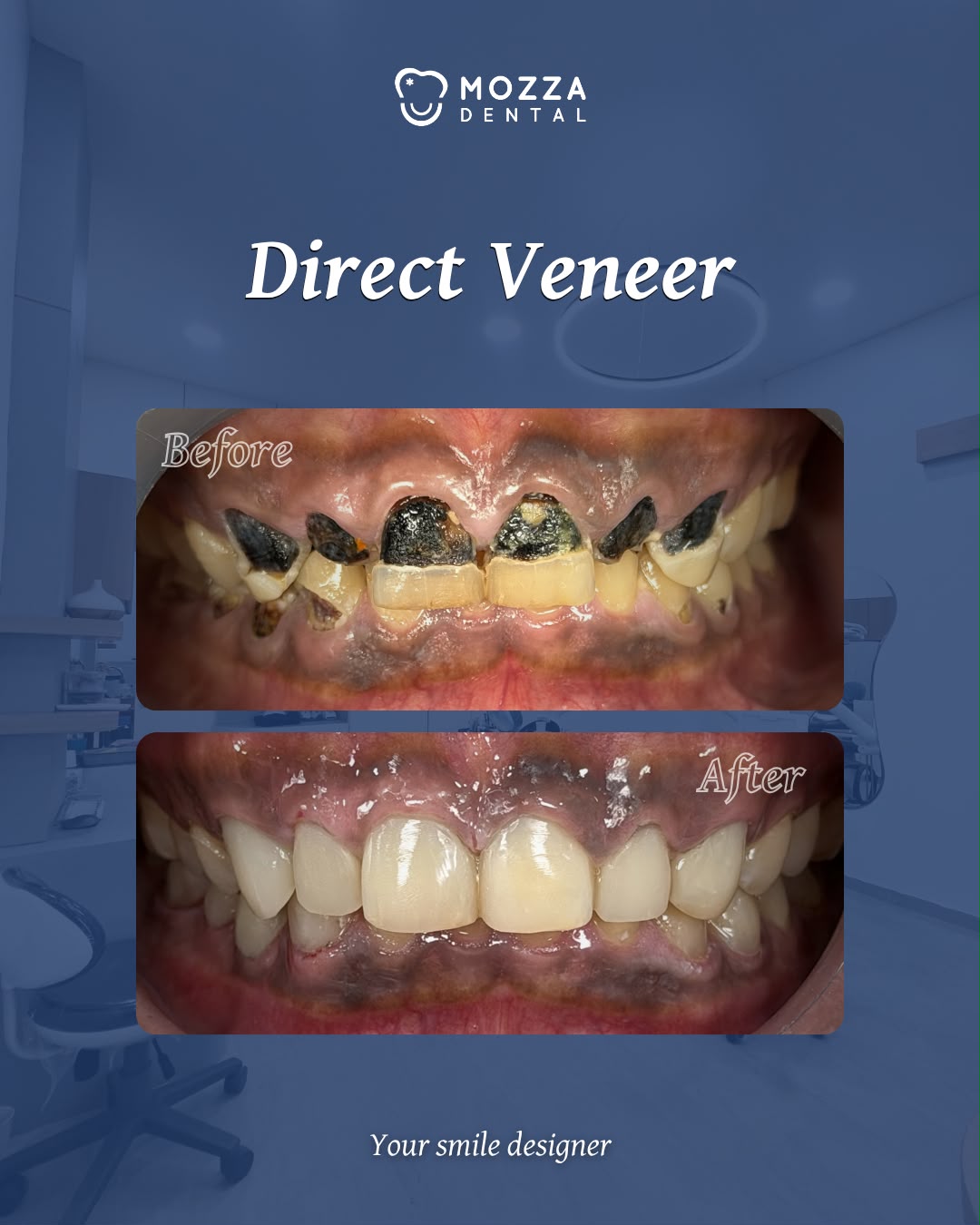 Direct Veneer Case 1