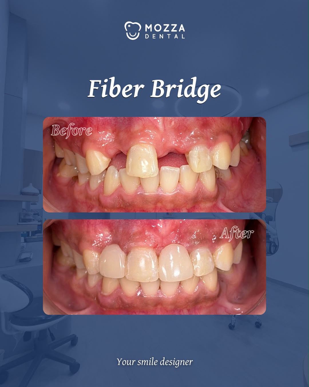 Fiber Bridge Case 1