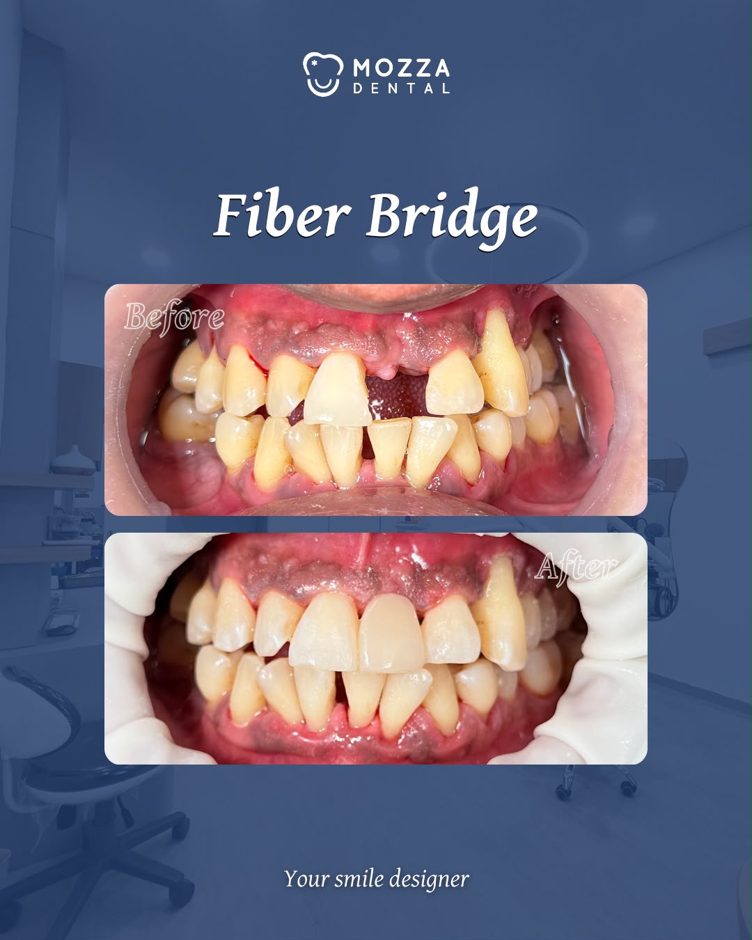Fiber Bridge Case 2