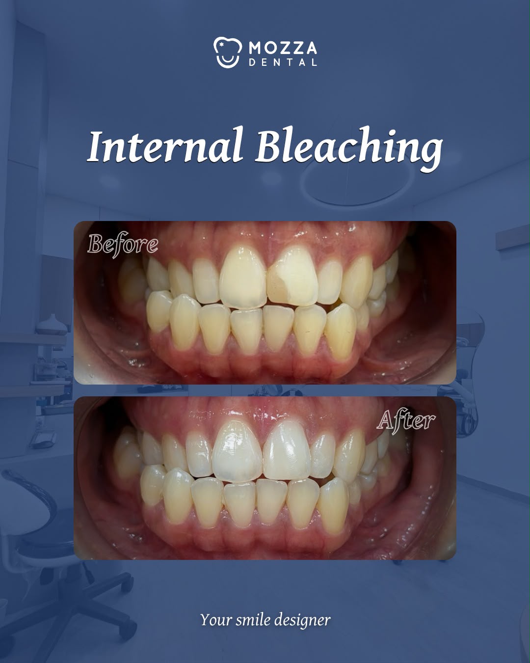 Internal Bleaching Gigi Mati