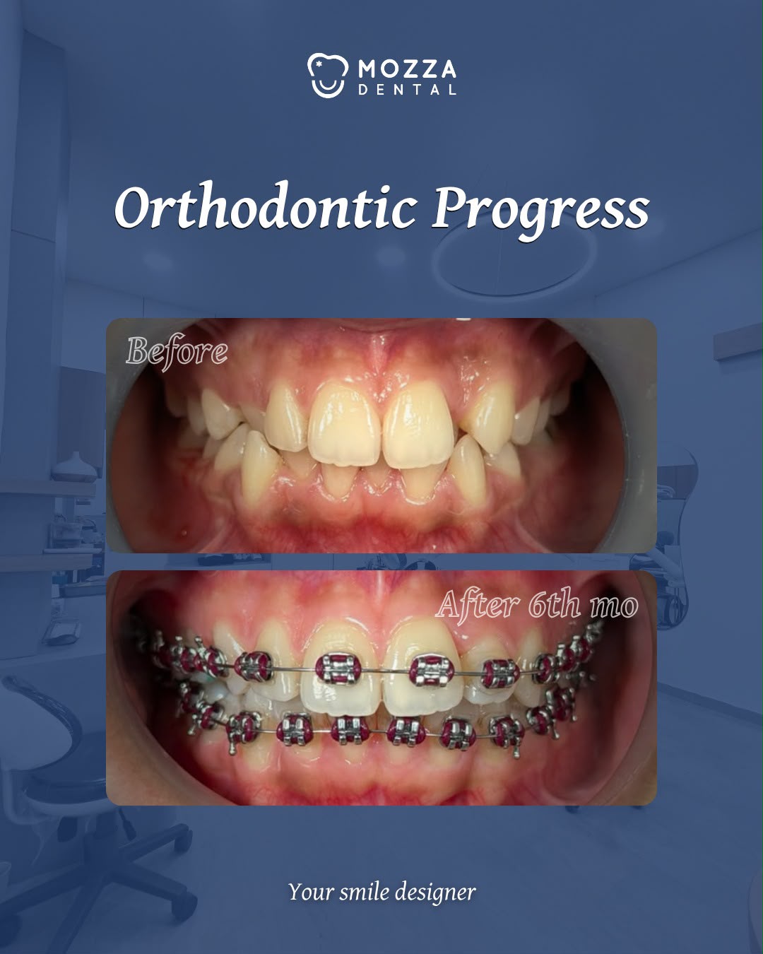 Orthodontic Progress