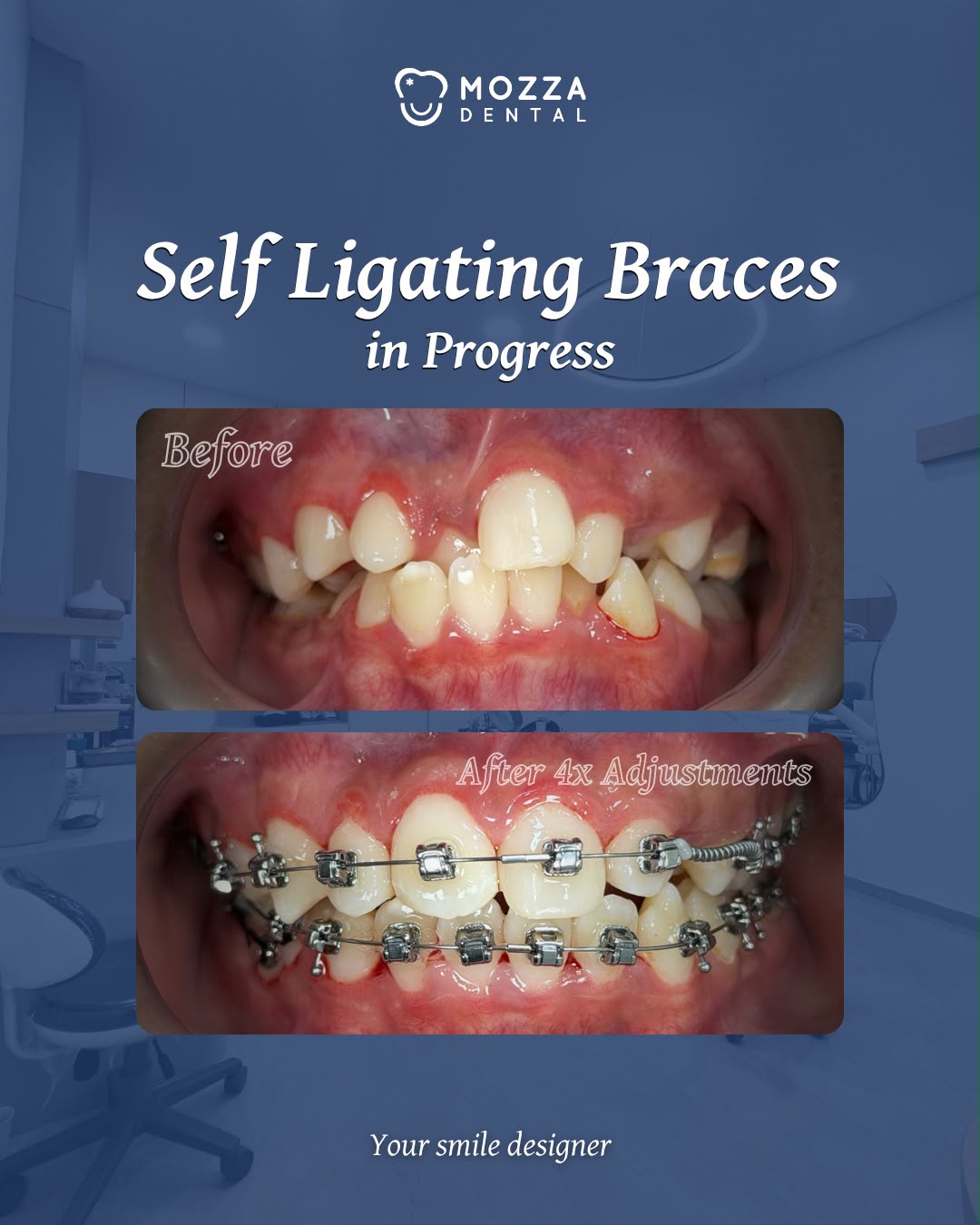 Self-Ligating Braces