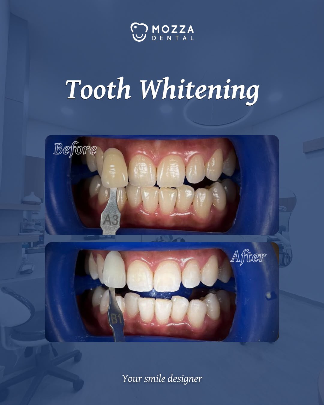 Tooth Whitening (Bleaching)