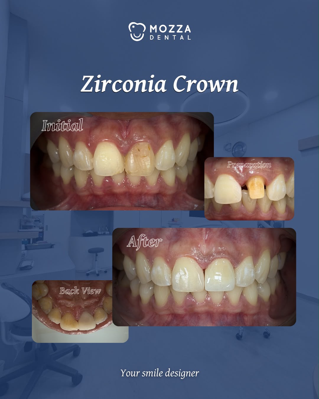 Zirconia Crown Restorasi